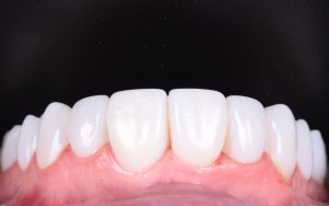 The Quick and Effective Way to a Beautiful Smile with London’s Composite Bonding